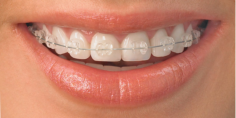 Orthodontic Treatments at PERFECT SMILE